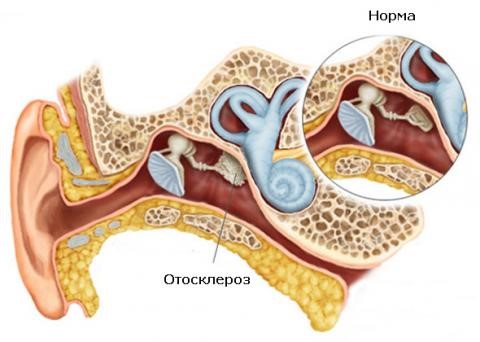 Kas ir otoskleroze diagnostika